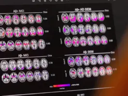 Nuevo método predice alzhéimer en personas sanas