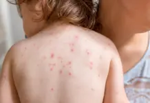 Estados Unidos bate récord de sarampión y alerta en niños: ¿Qué está pasando?