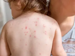 Estados Unidos bate récord de sarampión y alerta en niños: ¿Qué está pasando?
