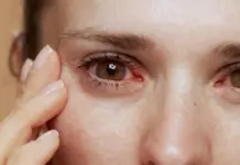 ¿Qué hacer si me duelen los ojos después del eclipse?
