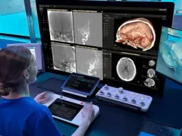 Philips, elegida por ARPA-H para aplicar IA y robótica al ictus