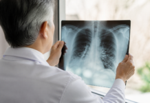 Fibrosis pulmonar: las señales que no debes pasar por alto