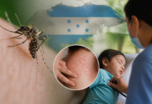 Honduras bajo alerta: aumentan dengue, sarampión y tos ferina
