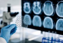 Grafeno: la clave para detectar daño cerebral tras un ictus
